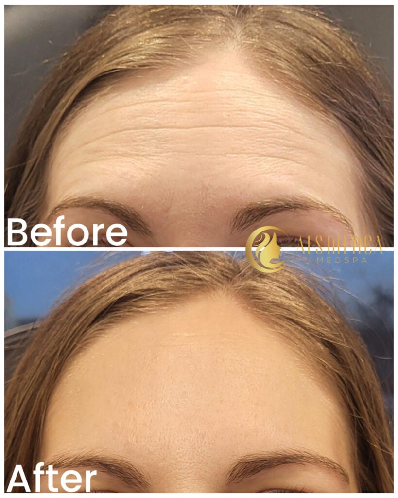 Forehead before and after Botox treatment at Aesthetica Med Spa in Paramus with visible wrinkle smoothing.