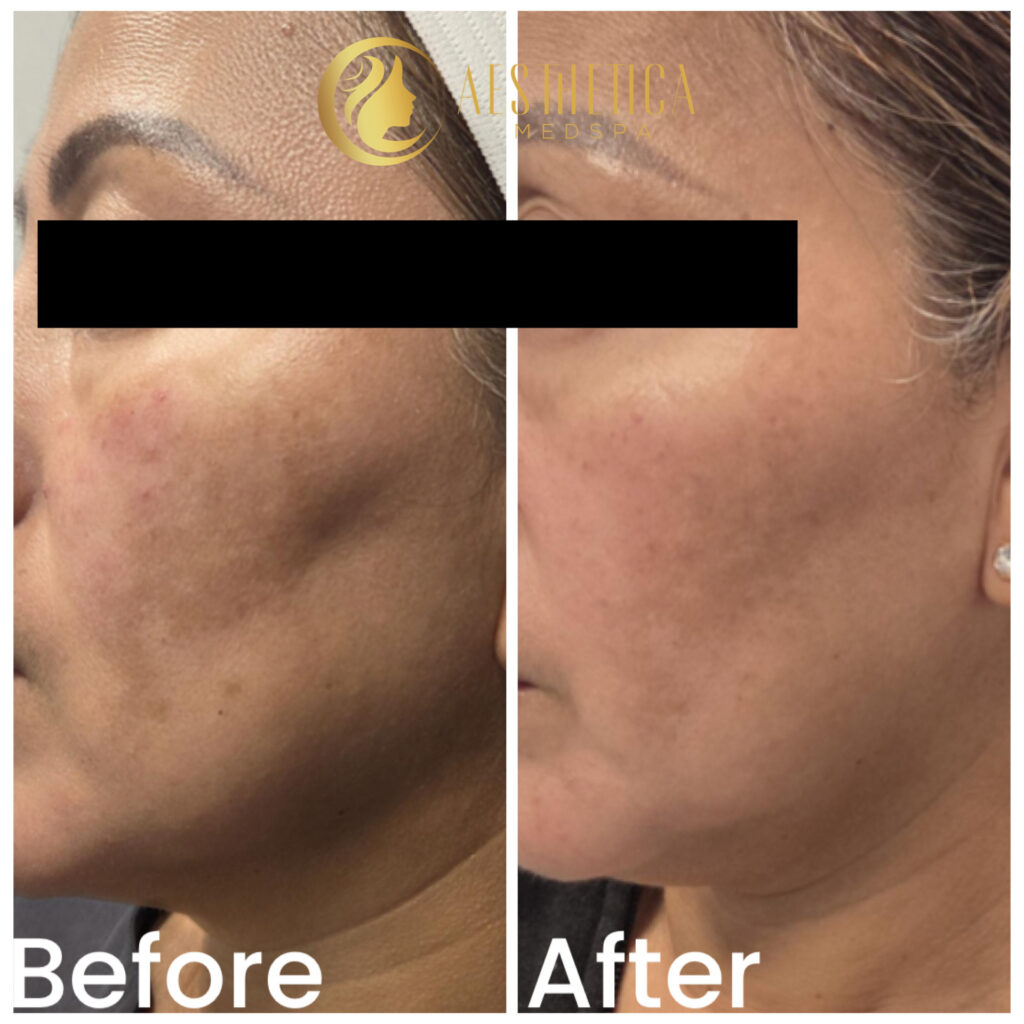 Chemical peel before and after on mature woman at Aesthetica Medspa in Paramus, NJ showing smoother, clearer skin.