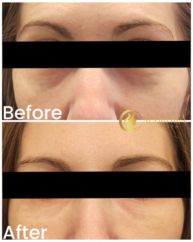 Aesthetica Med Spa Paramus, NJ undereye filler on woman reducing dark circles and hollows.