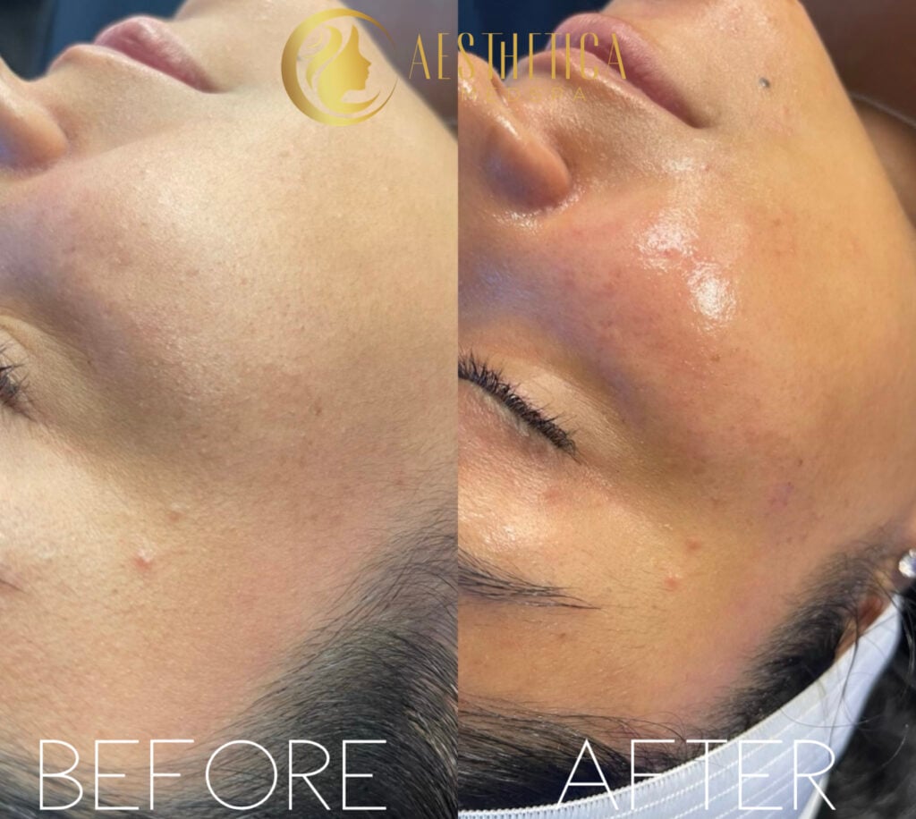 Aesthetica Med Spa Paramus, NJ HydraFacial before and after highlighting improved skin texture and glow.