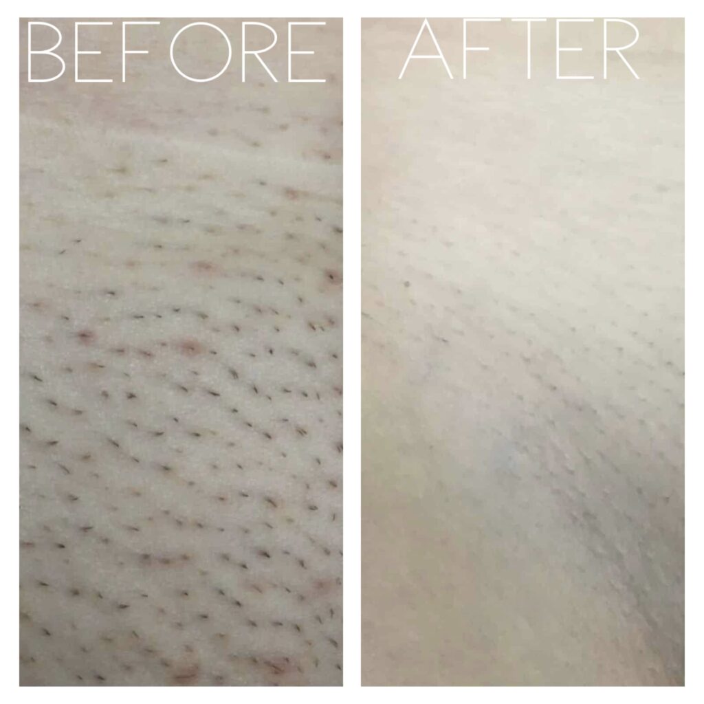 Close-up before and after Brazilian laser hair removal at Aesthetica Med Spa in Paramus, NJ with hair-free smooth skin.