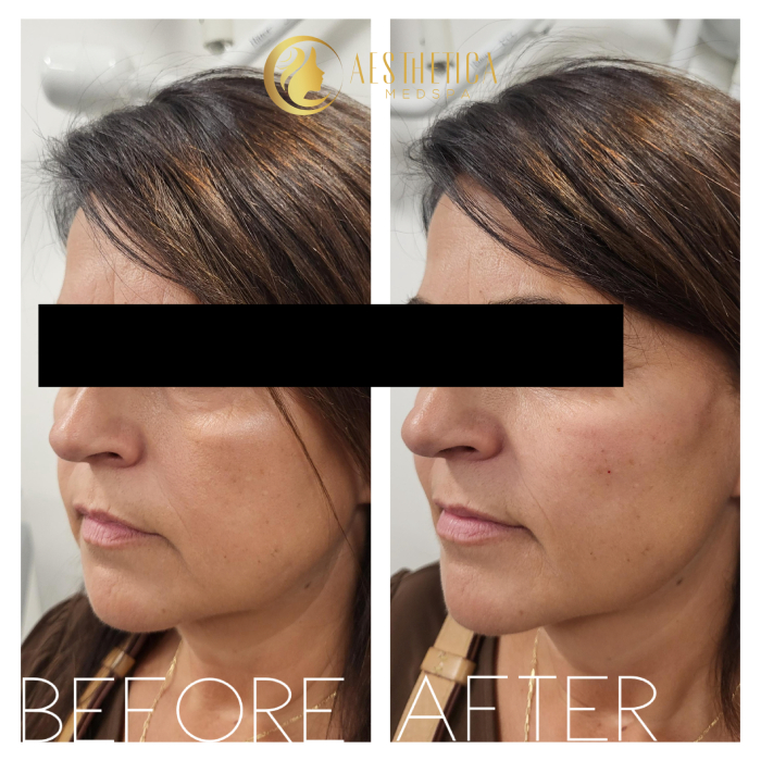 Aesthetica Med Spa Paramus, New Jersey cheek filler creating natural lift in mature woman’s face.