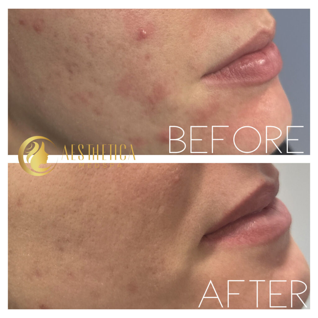 Aesthetica Medspa Paramus, New Jersey chemical peel on woman showing brighter, clearer skin.