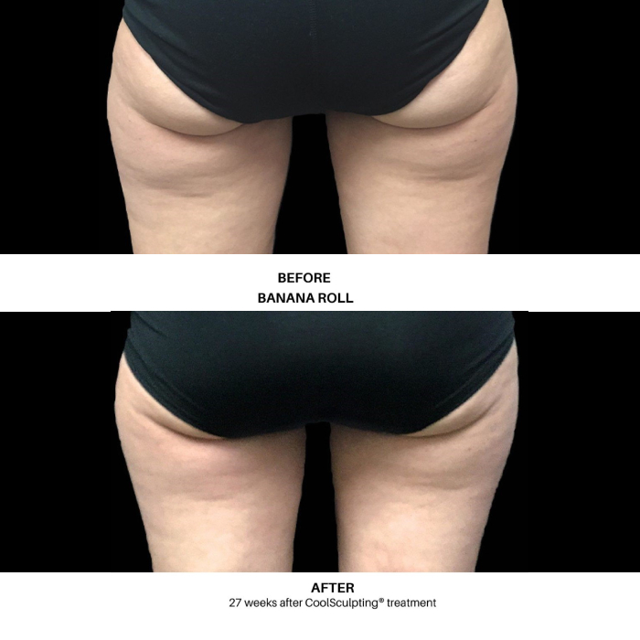 CoolSculpting® for Men