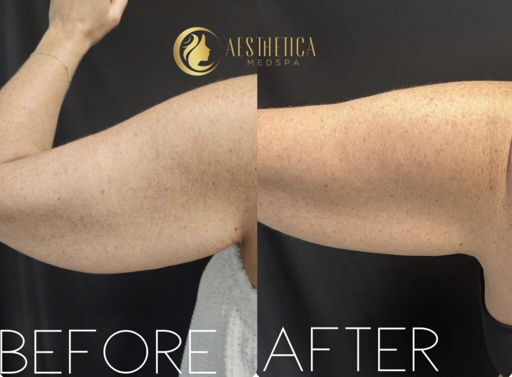 Woman before and after CoolSculpting on arms at Aesthetica Med Spa in Paramus, NJ showing fat reduction.