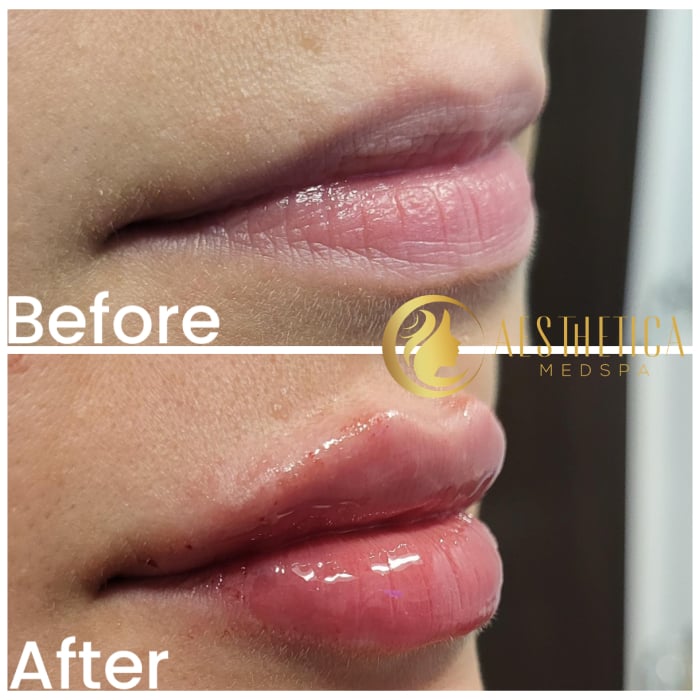 Botox lip flip results on young woman at Aesthetica Medspa, Paramus New Jersey