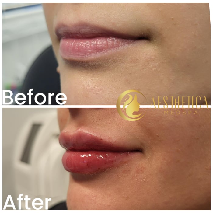 Young woman before and after Botox lip flip at Aesthetica Med Spa in Paramus, NJ showing fuller lips.