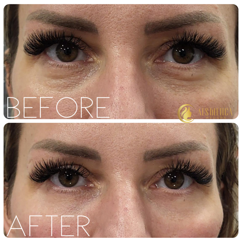 Young woman before and after dermal fillers at Aesthetica Med Spa in Paramus, NJ reducing under-eye hollows.