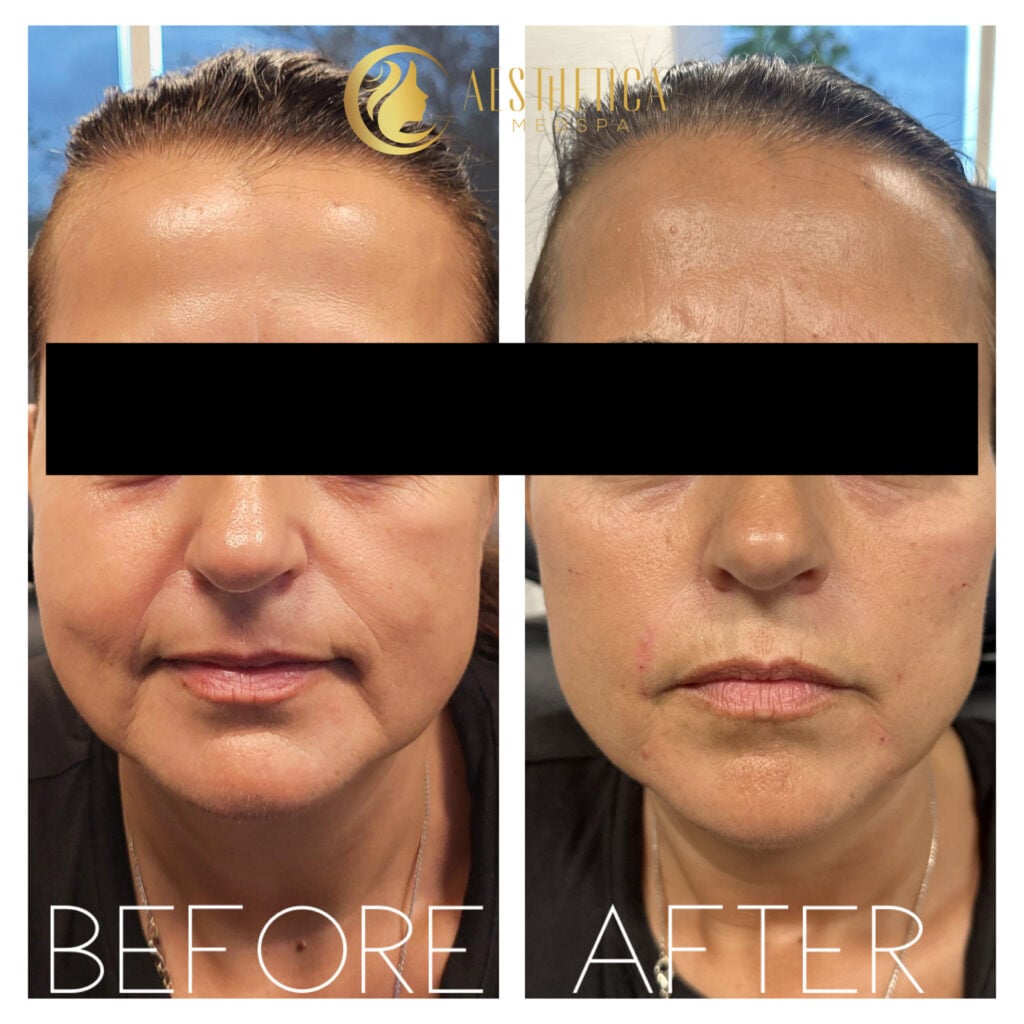 Woman at Aesthetica Med Spa Paramus, NJ before and after cheek filler for lifted contour.
