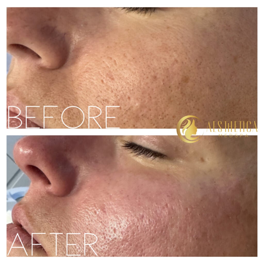 Woman’s skin appears brighter and refreshed after HydraFacial at Aesthetica Medspa Paramus.