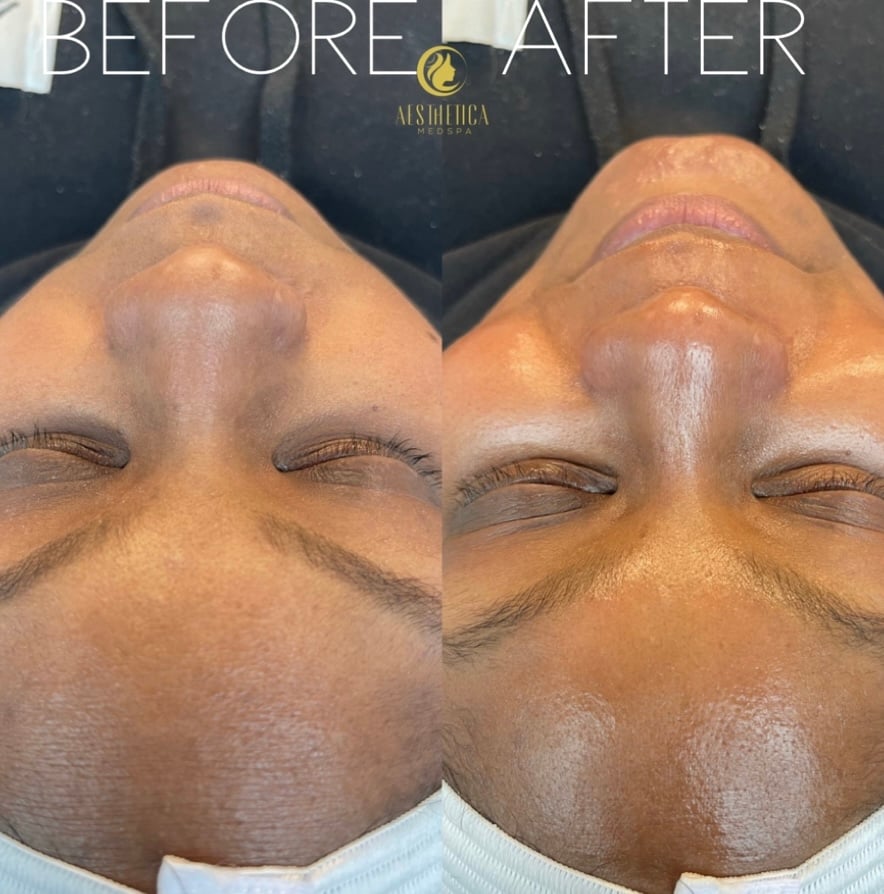 Aesthetica Med Spa Paramus, NJ HydraFacial before and after highlighting improved skin texture and glow.