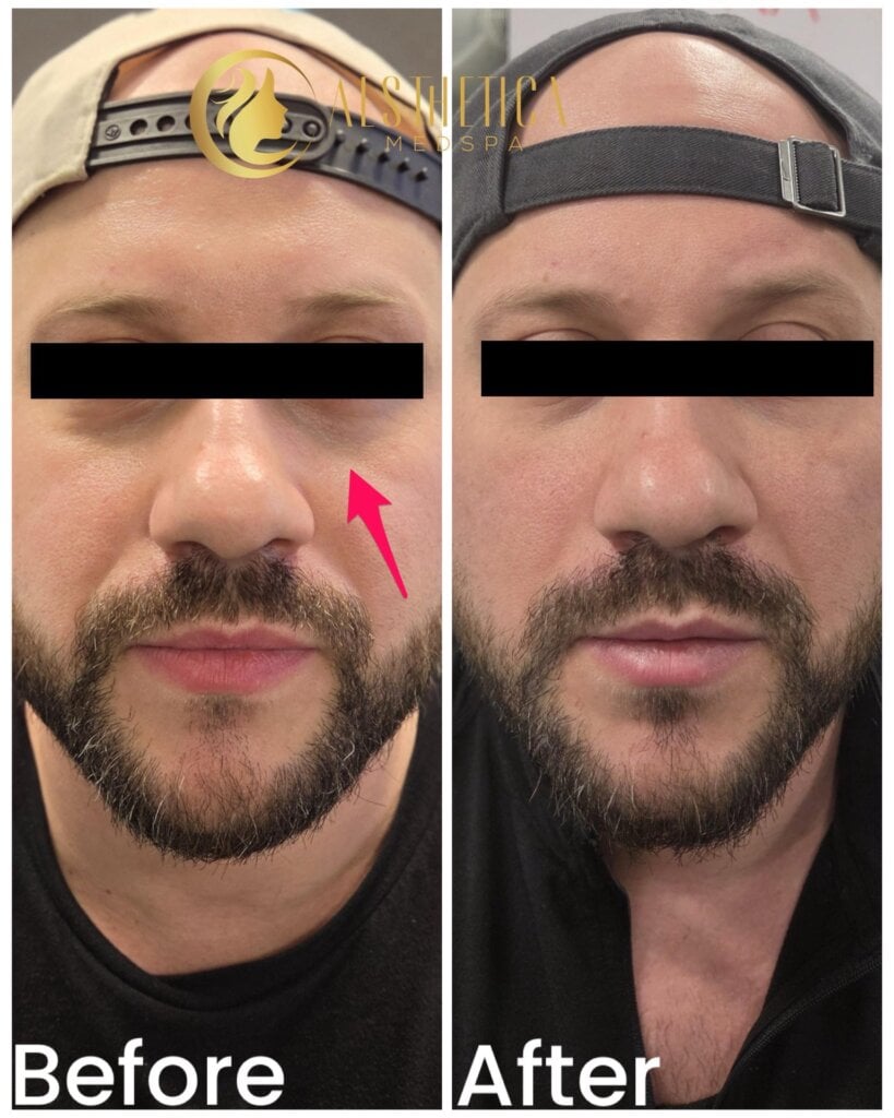 Before and after comparison of a man's nose area showing improved skin texture after cosmetic treatment; arrow highlights the area.