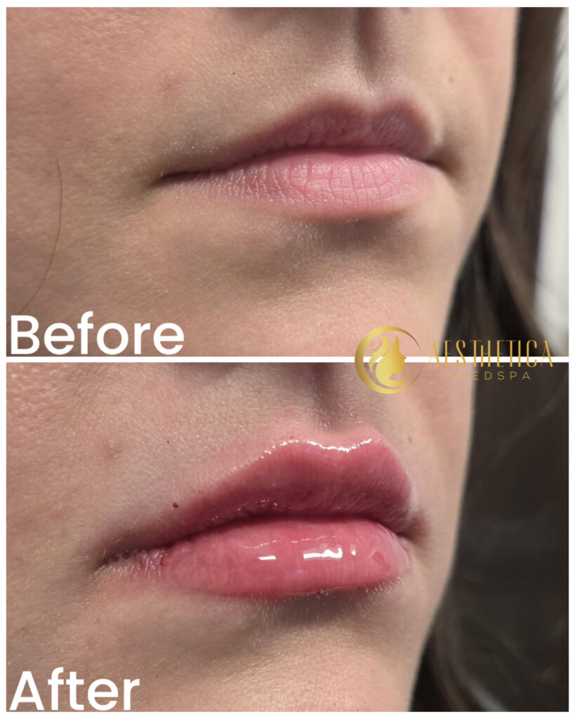 Close-up of a woman's lower face after a cosmetic treatment: smooth skin texture and pink lips; 'After' text visible in the corner.