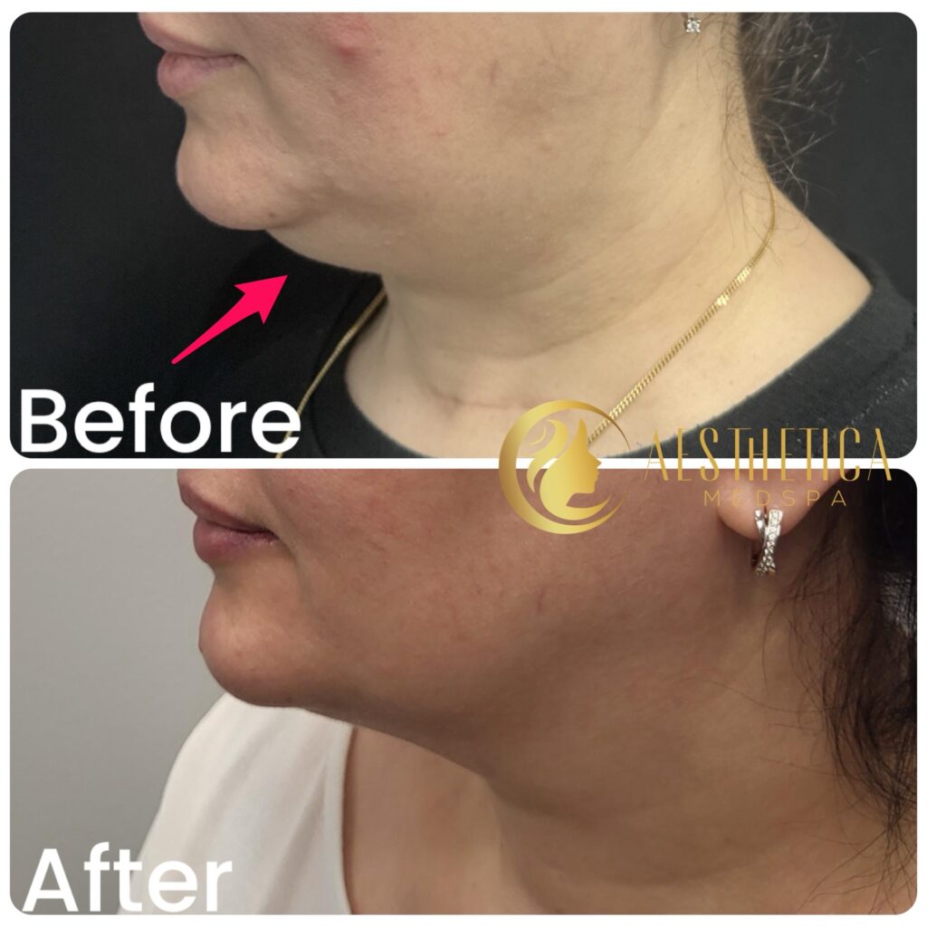 Non-surgical double chin CoolSculpting results at Aesthetica Med Spa, Paramus, New Jersey with visible fat reduction.