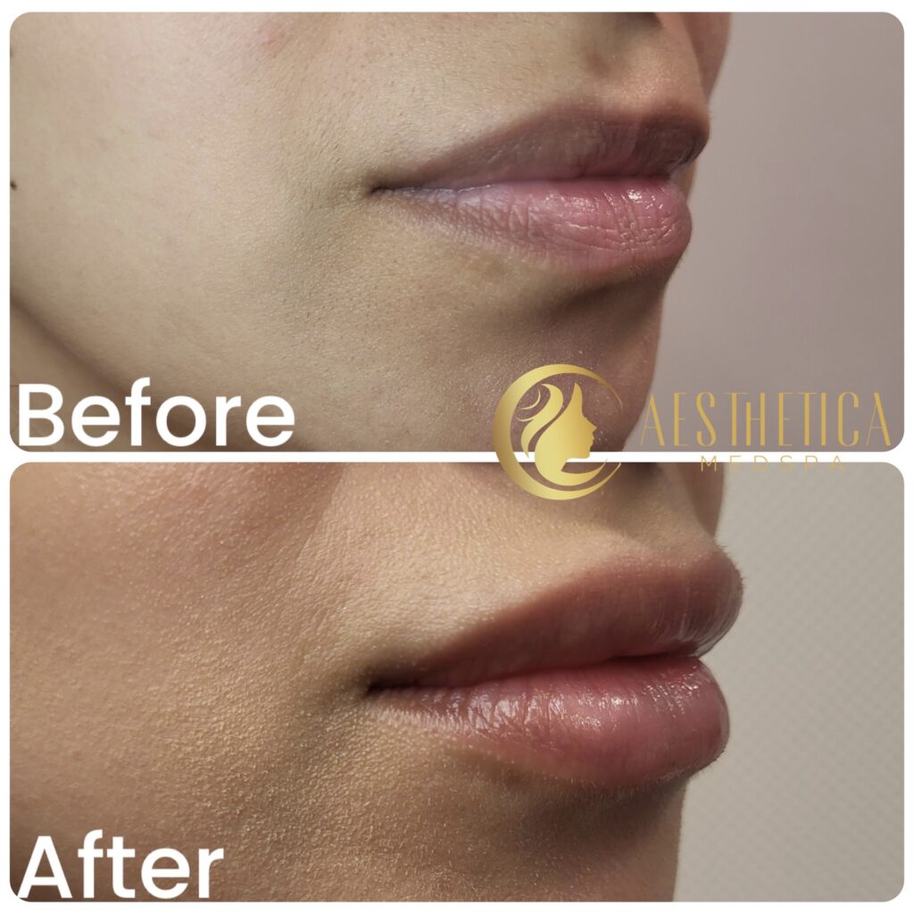 Lip filler before and after at Aesthetica Medspa in Paramus, NJ showing fuller lips on young woman.
