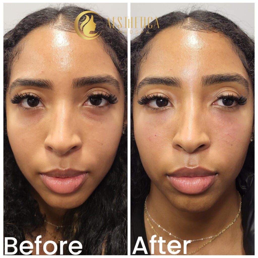 Dermal Fillers