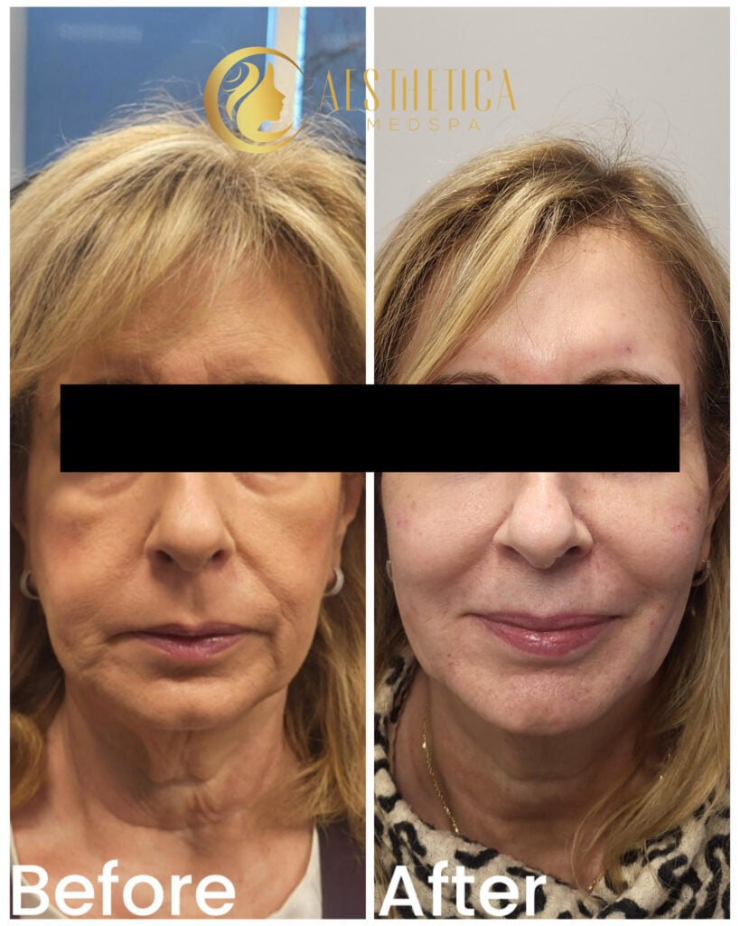 Dermal Fillers