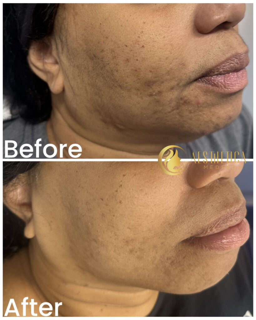 Skin rejuvenation with chemical peel at Aesthetica Med Spa in Paramus showing brighter, smoother texture.