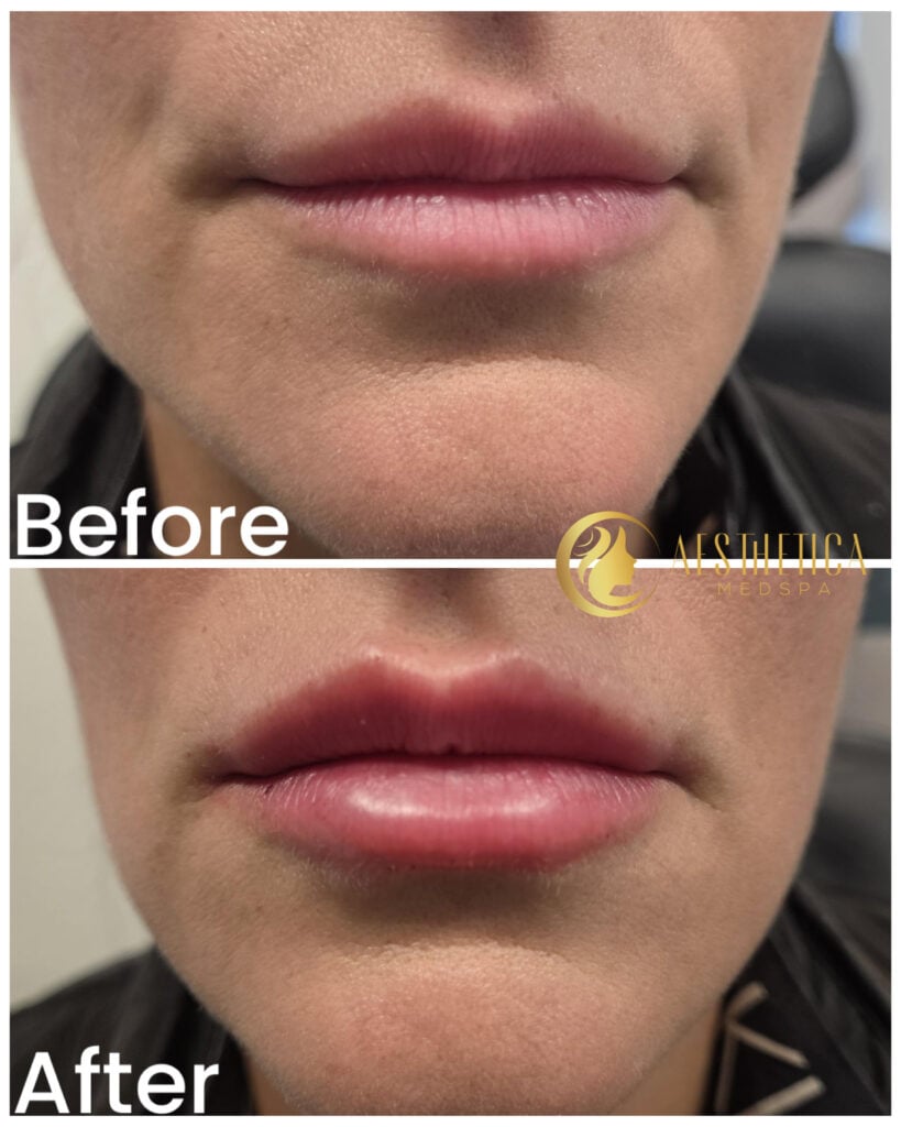 Dermal Fillers