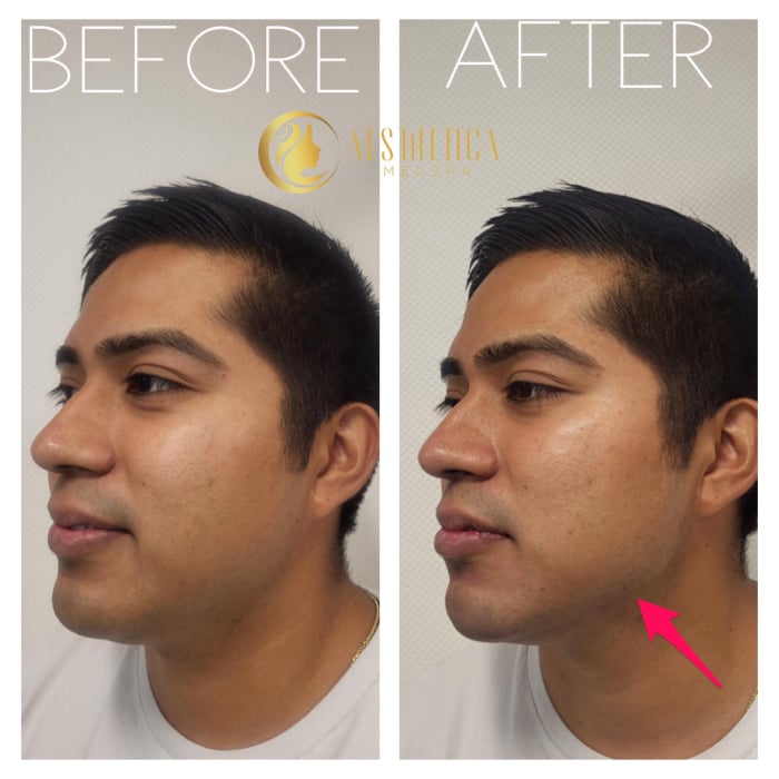 Jawline dermal filler results on male patient at Aesthetica Medspa, Paramus New Jersey creating a sharper contour.