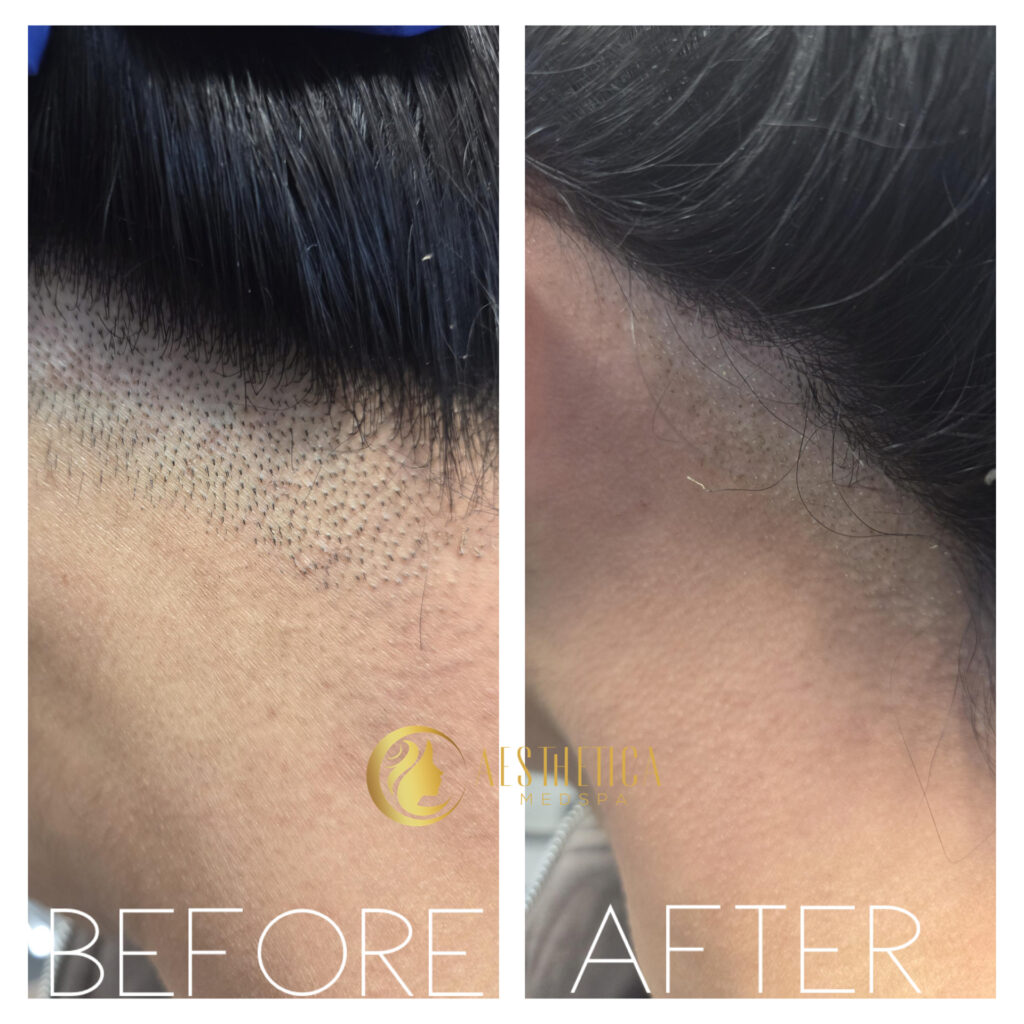 Smooth skin achieved after laser hair removal treatment at Aesthetica Med Spa in Paramus.