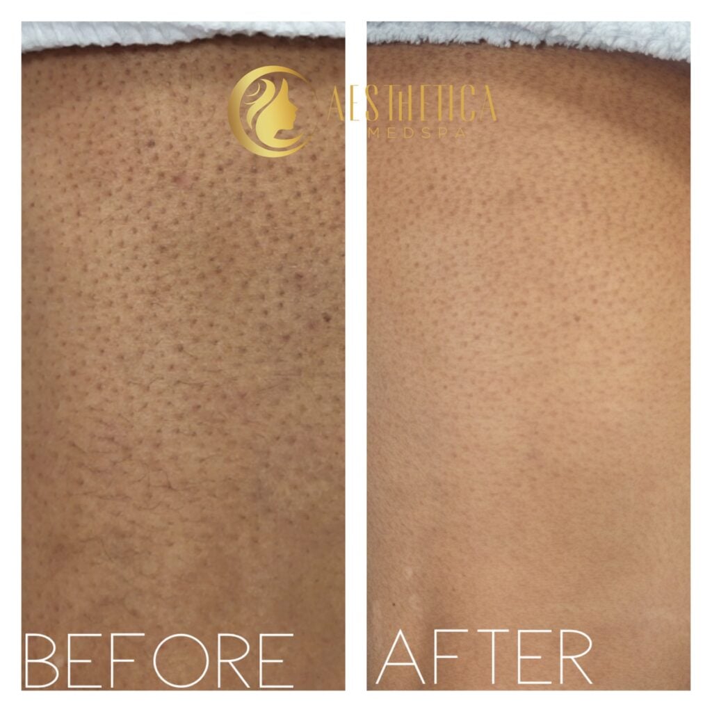 Laser hair removal results at Aesthetica Medspa, Paramus New Jersey with clear, hair-free skin.