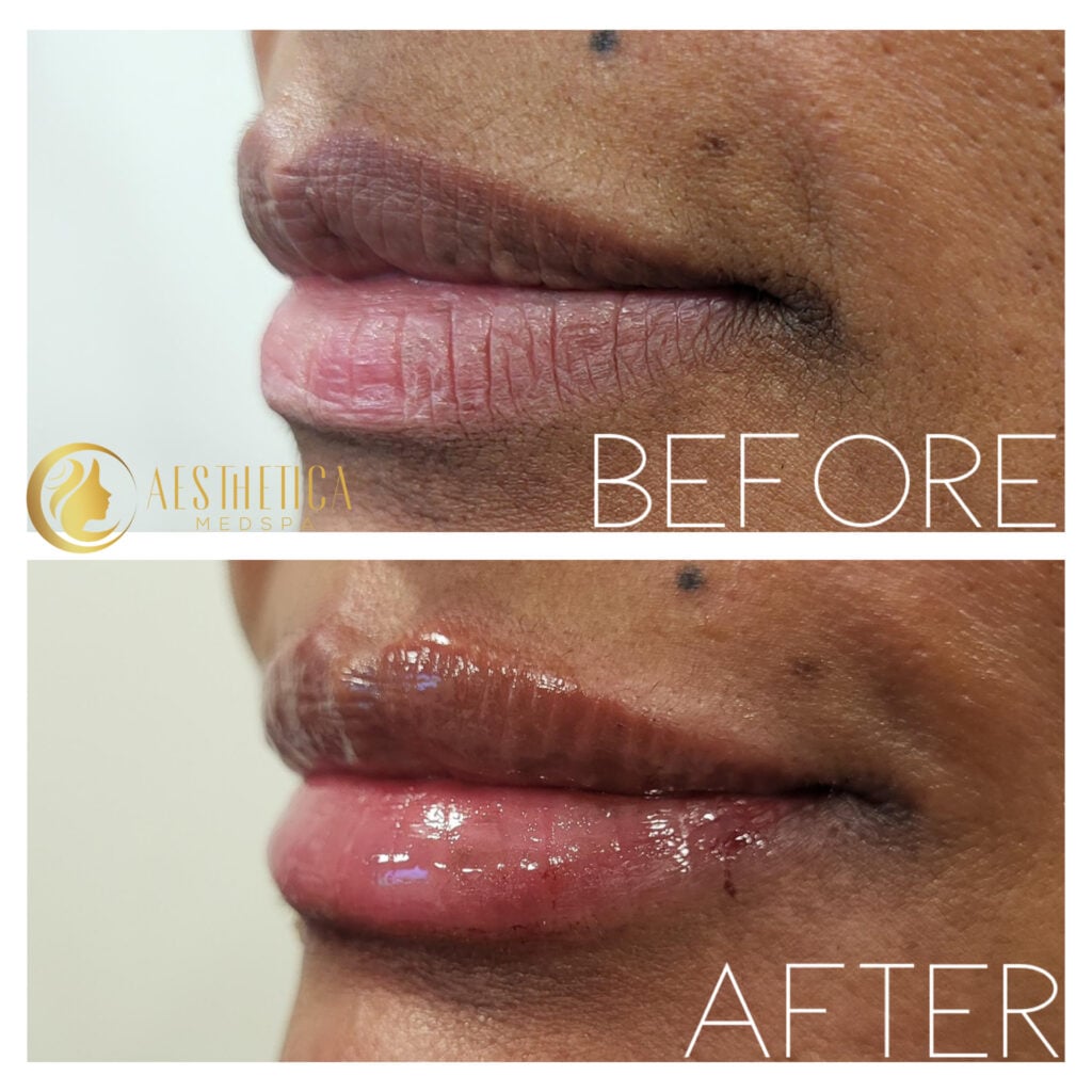 Lip filler results on woman at Aesthetica Medspa, Paramus New Jersey with enhanced natural lip volume.