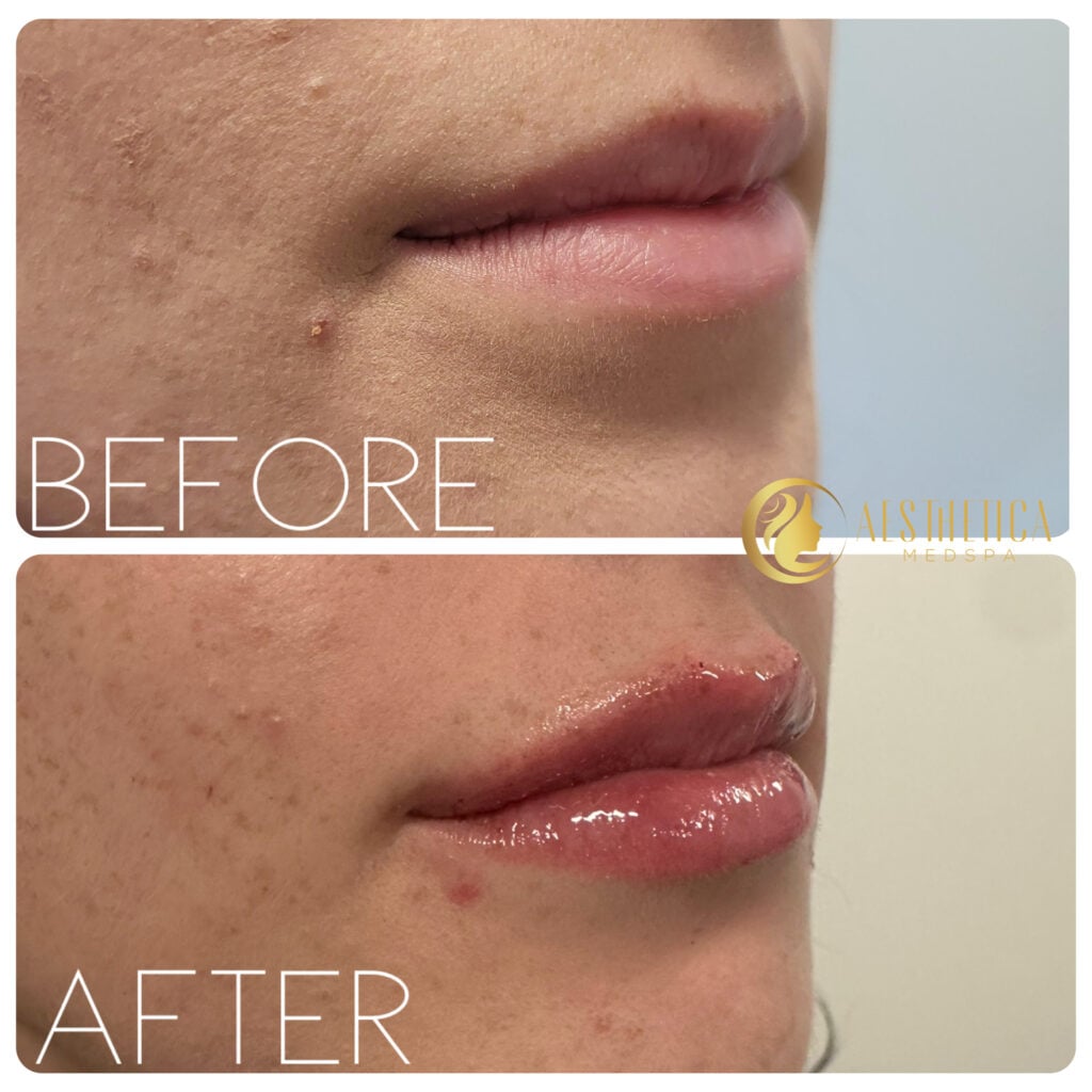 Young woman before and after lip filler at Aesthetica Med Spa in Paramus, NJ showing fuller lips.