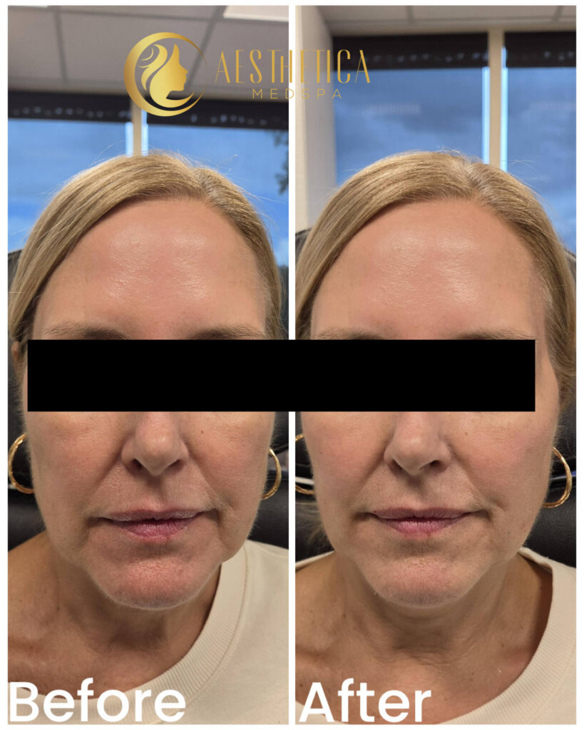 Dermal Fillers