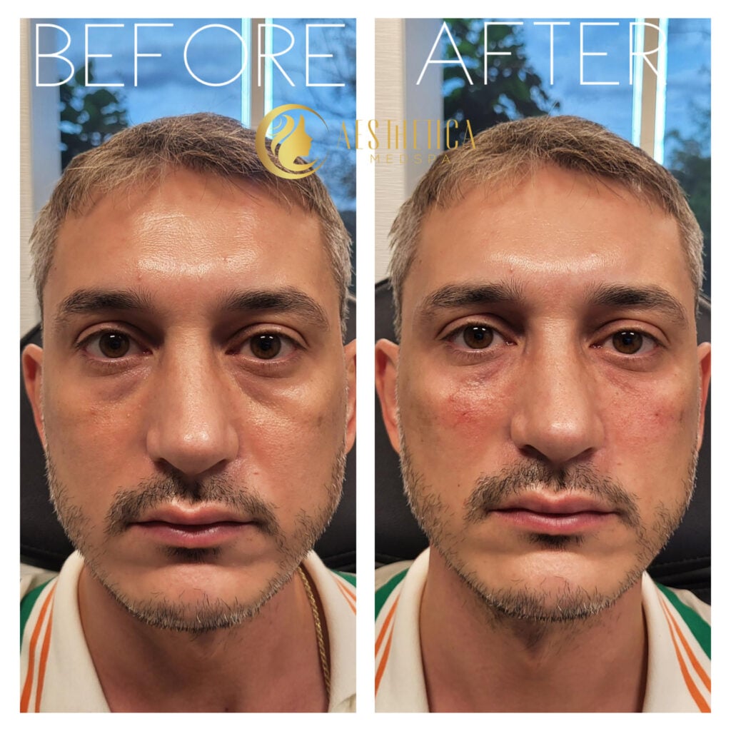 Male patient before and after under-eye dermal fillers at Aesthetica Med Spa in Paramus, NJ.