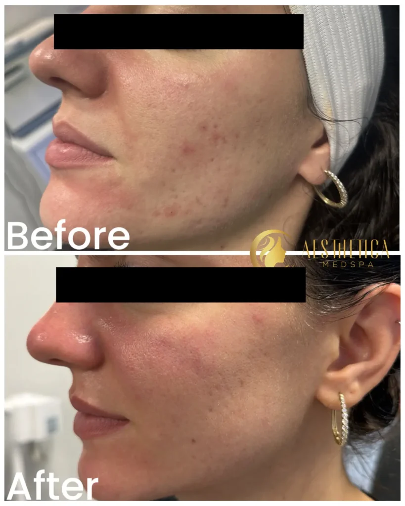 Close-up side profile of a woman's cheek with acne and redness, labeled 'Before' for a cosmetic treatment.