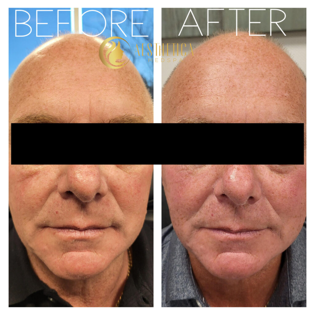 Face rejuvenation after Sylfirm X skin tightening on a man at Aesthetica Med Spa in Paramus.