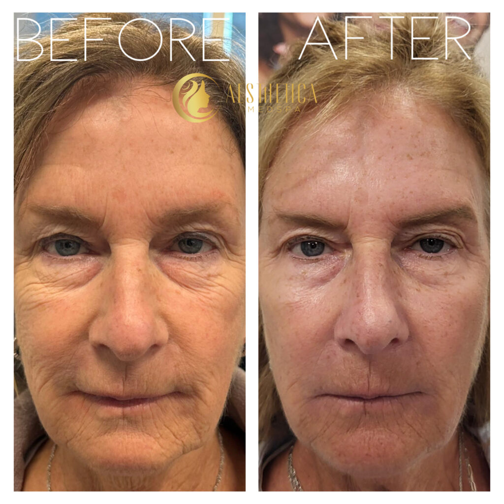 Mature woman before and after Sylfirm X face skin tightening at Aesthetica Med Spa in Paramus, NJ.