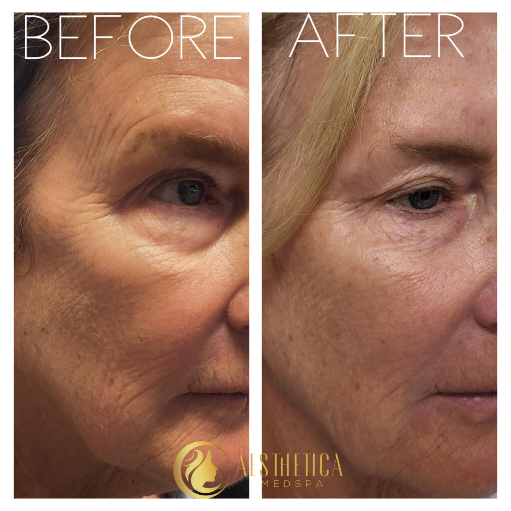Woman before and after Sylfirm X face skin tightening at Aesthetica Med Spa in Paramus, NJ.