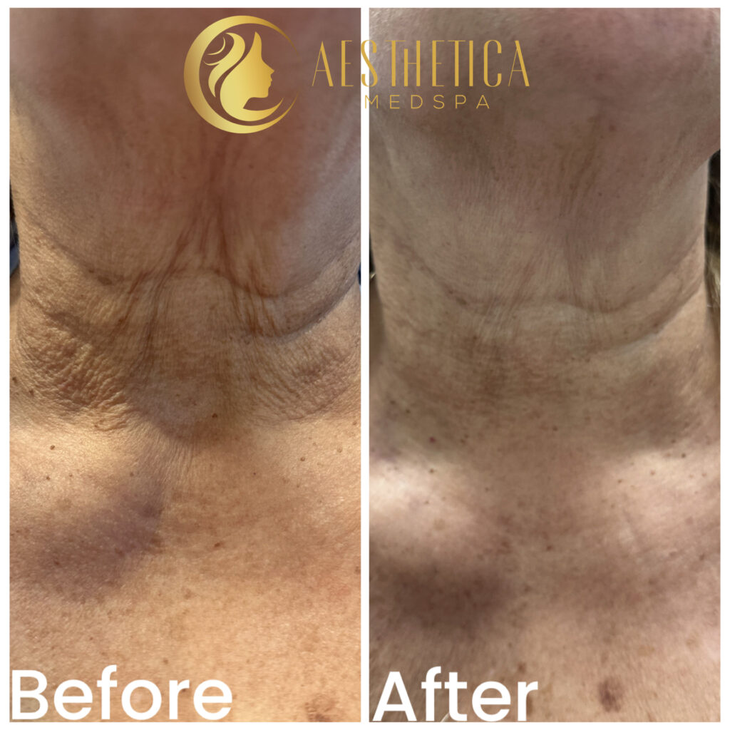 Mature woman neck Sylfirm X skin tightening before and after at Aesthetica Med Spa Paramus, NJ.