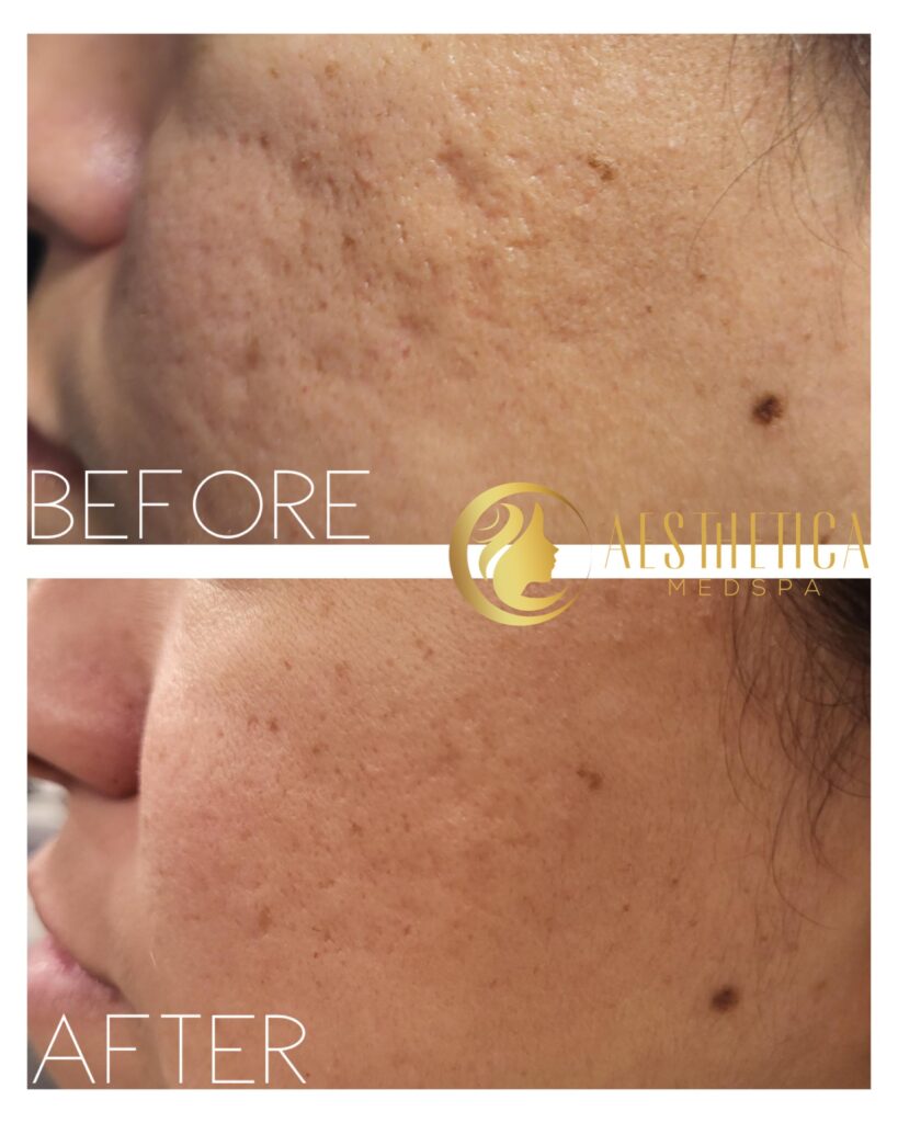 Acne scars improved after Sylfirm X facial skin tightening on woman at Aesthetica Med Spa in Paramus.