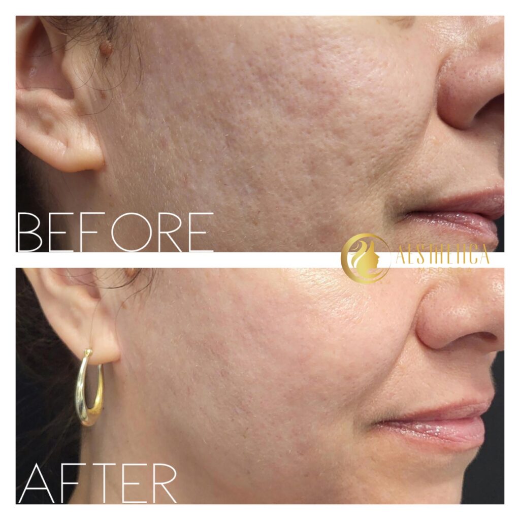 Sylfirm X treatment for face at Aesthetica Medspa, Paramus New Jersey showing firmer, youthful skin.