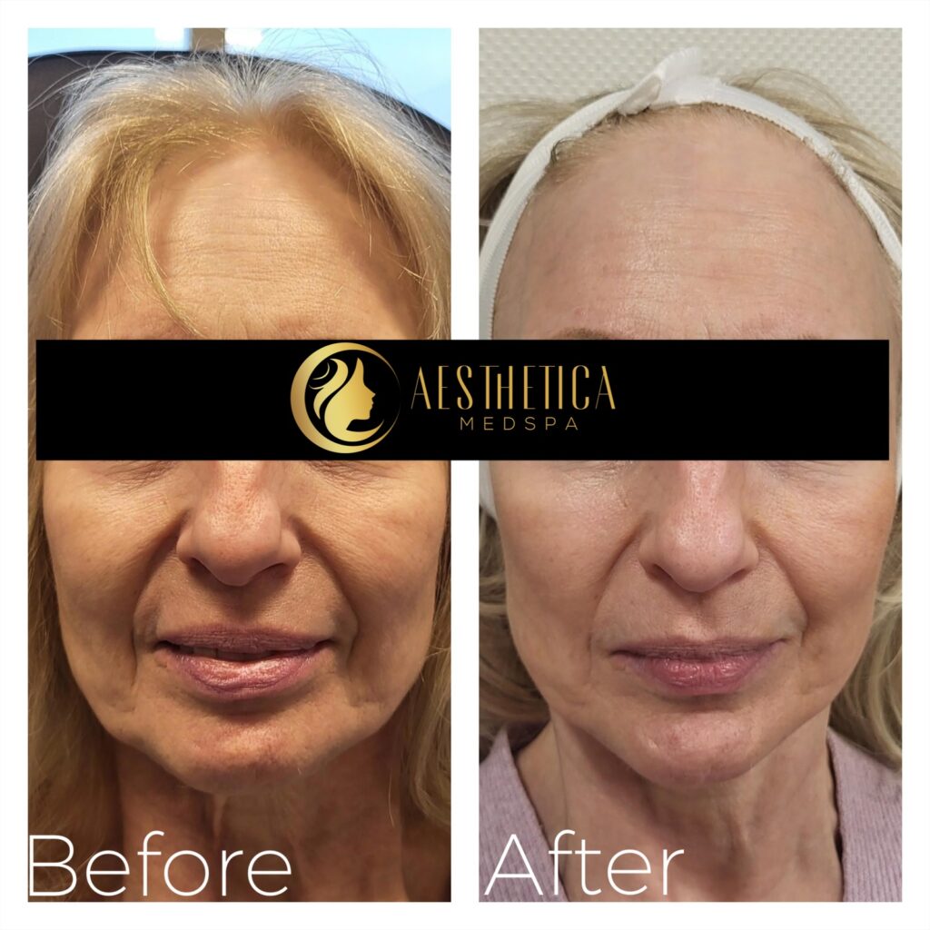 Sylfirm X face treatment on mature woman at Aesthetica Medspa, Paramus New Jersey showing firmer skin.