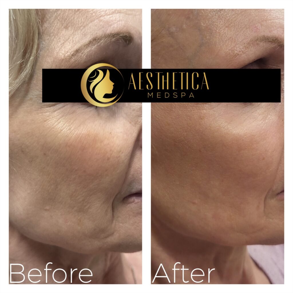 Face rejuvenation with Sylfirm X on mature woman at Aesthetica Med Spa in Paramus.