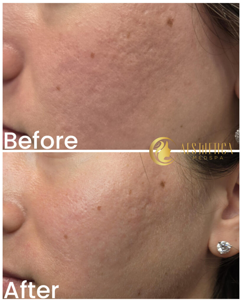 Close-up of a woman's cheek labeled 'Before' and 'After' showing skin texture and small brown spots, with Aesthetica branding nearby.