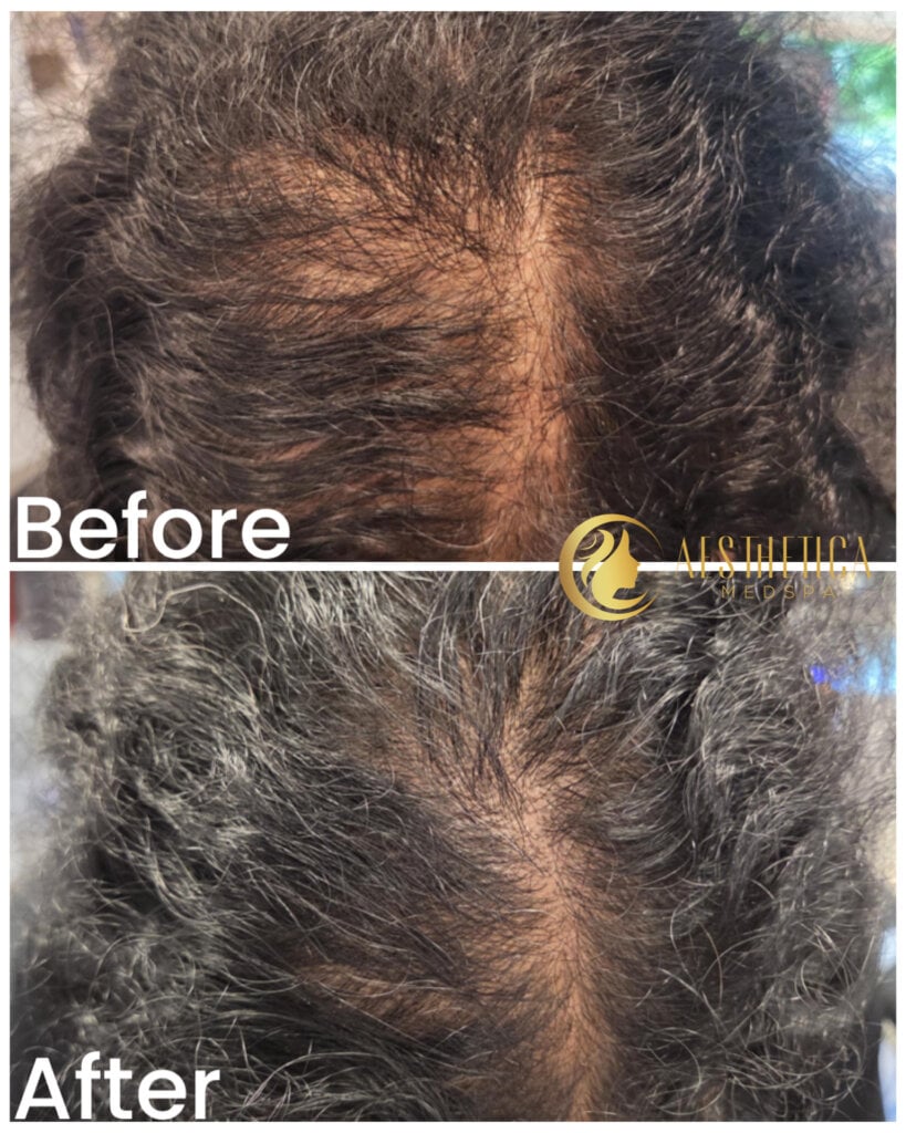 Close-up of a scalp with hair thinning, labeled 'Before' and 'After' to show hair restoration progress.