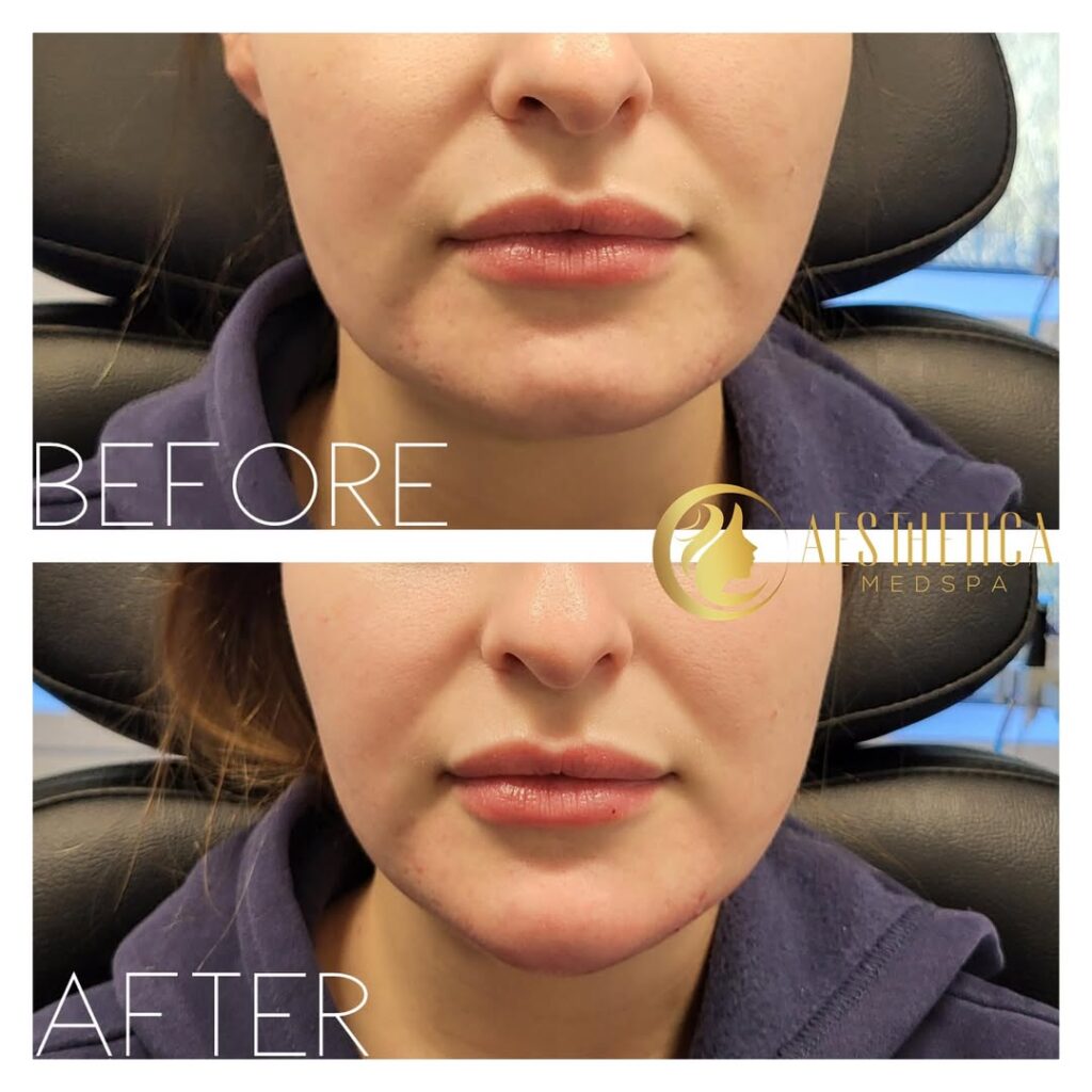 young woman with chin fillers in Paramus, NJ
