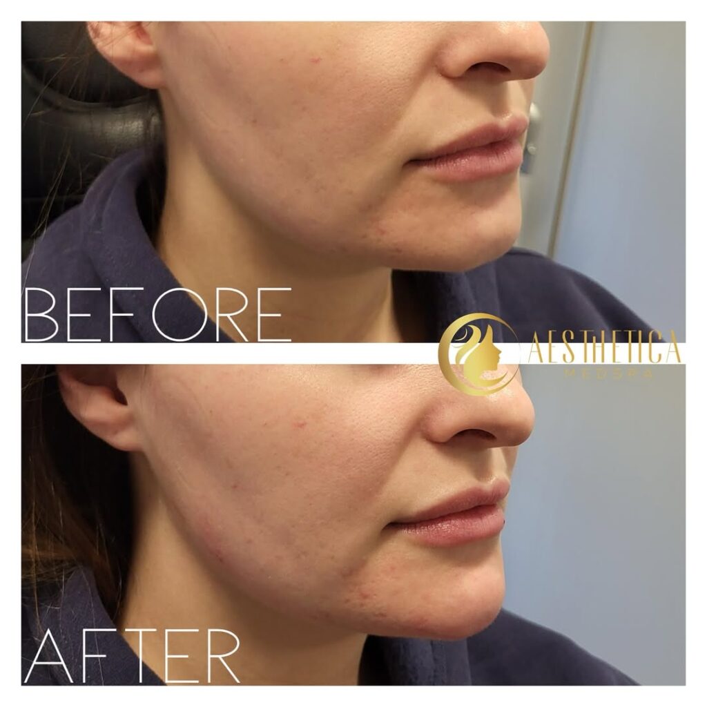 Before and after results of young woman who received Chin Fillers at Aesthetica Medspa