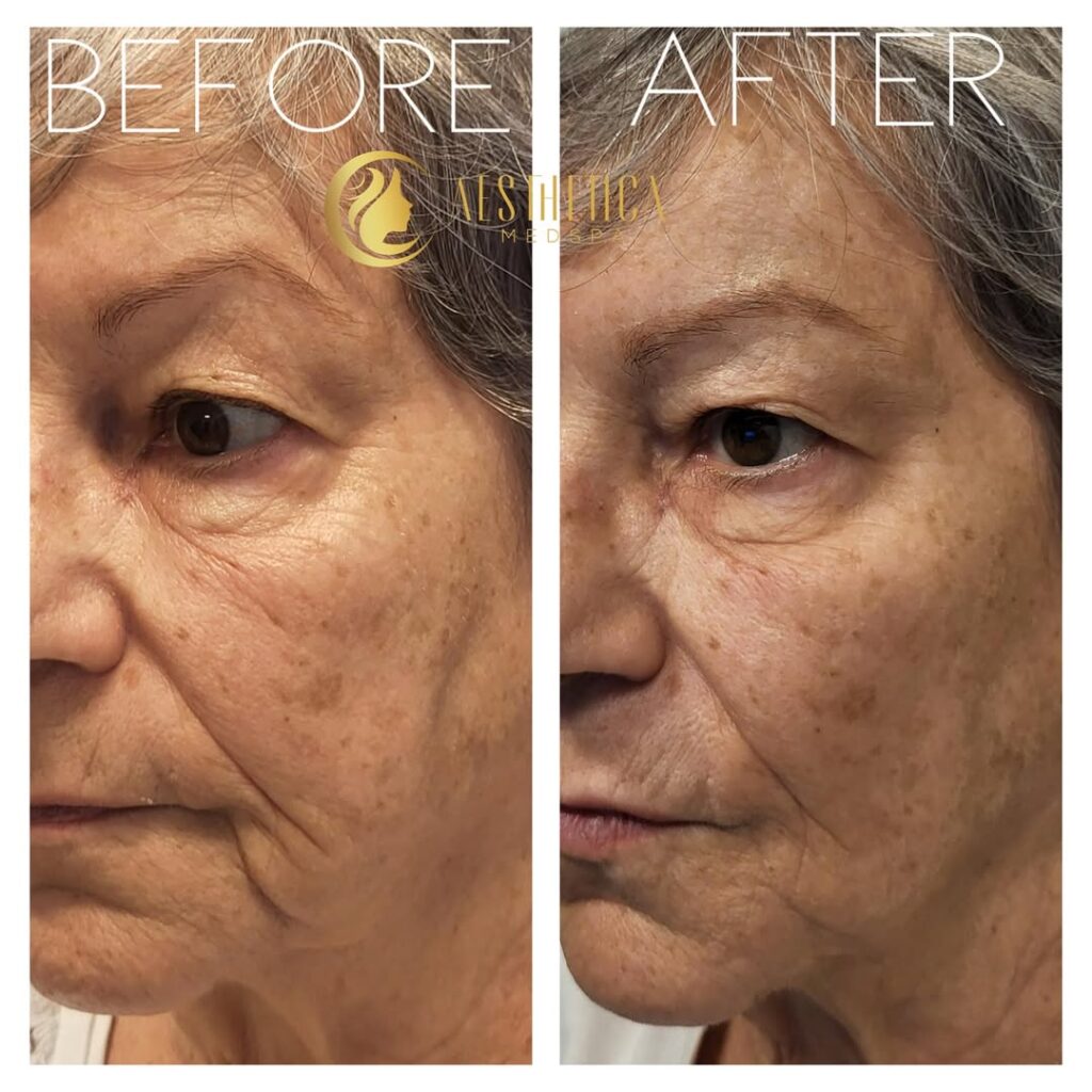 mature woman who received chin filler at Aesthetica Medspa