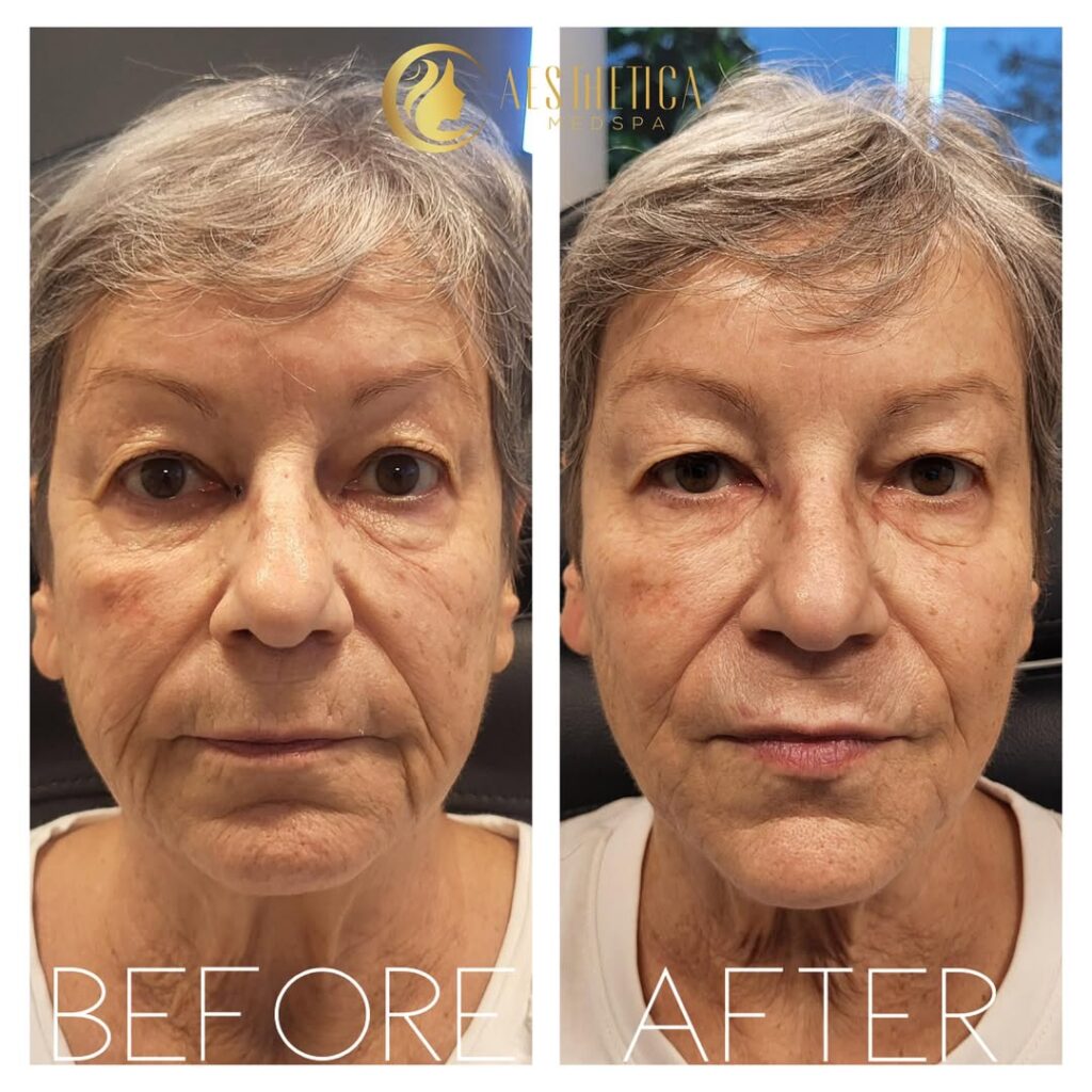 woman who received chin filler at Aesthetica Med Spa in New Jersey