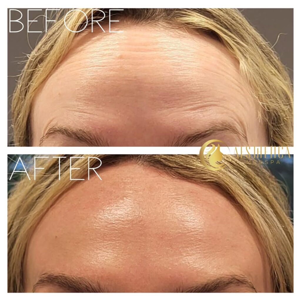 Before and after frown line fillers at Aesthetica Medspa in Paramus, NJ showing smoother forehead results.
