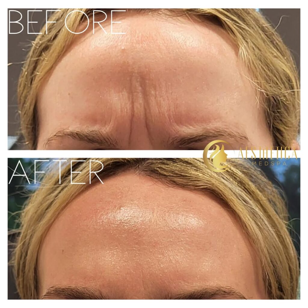 Aesthetica Med Spa in New Jersey showcases before and after frown line filler treatment with smoother skin.
