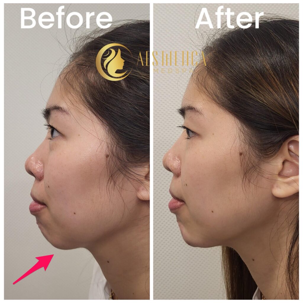 Before and after chin filler results on young woman at Aesthetica Med Spa in Paramus, New Jersey.