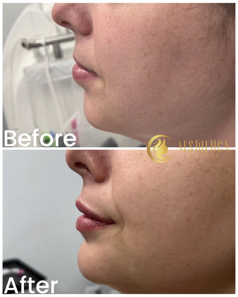 Side profile of the lower face and jawline showing improved contour after cosmetic treatment; 'After' label visible in corner.