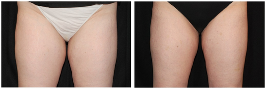 CoolSculpting® for Men